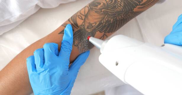 Sesiones de eliminación de tatuajes en Adansonia Centro de Estética