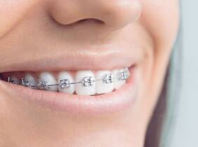 Tratamiento dental con brackets