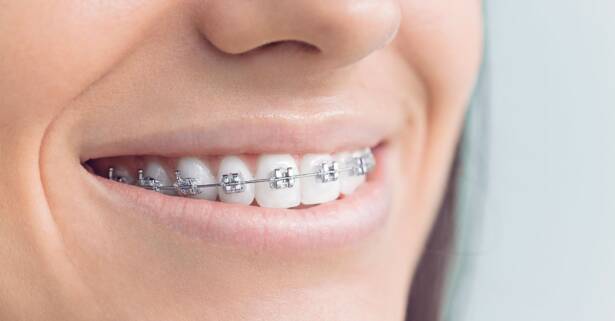 Tratamiento dental con brackets