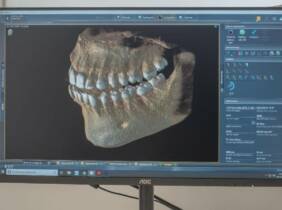 TAC dental con estudio 3D