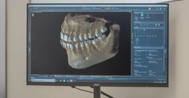 TAC dental con estudio 3D