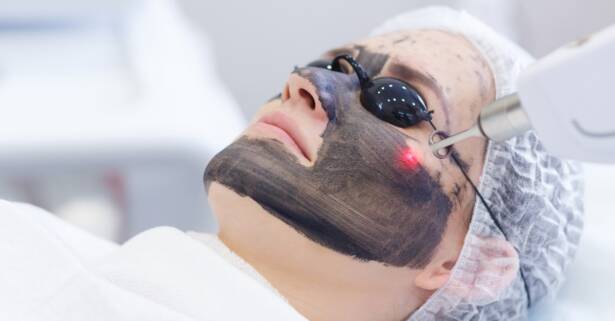 Tratamiento facial y peeling de carbono activo 4D