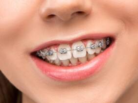 Ortodoncia a elegir en Clínica Dental Dra Sandra Vargas