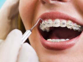 Ortodoncia con brackets metálicos en C&S Dental Alhaurin