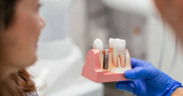 Implantes dentales con corona que transformarán tu sonrisa