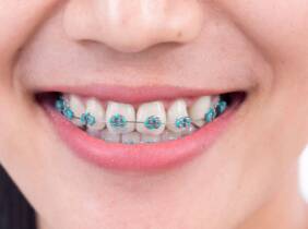 Ortodoncia completa con brakets