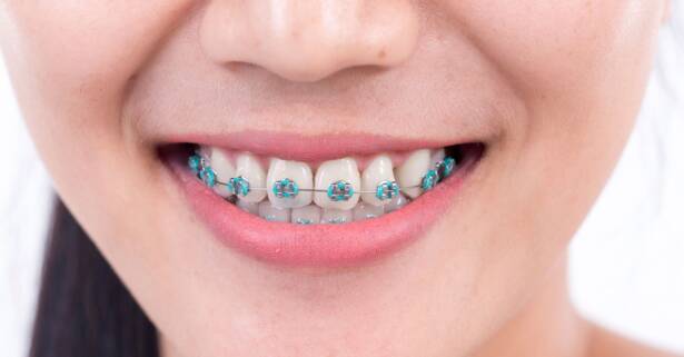 Ortodoncia completa con brakets