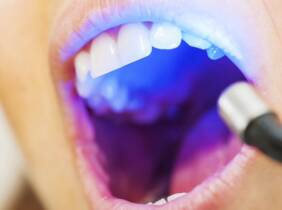 Blanqueamiento dental LED