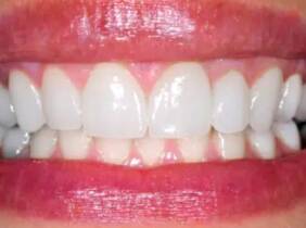 Blanqueamiento dental con led en Clínica Dental Odontoss