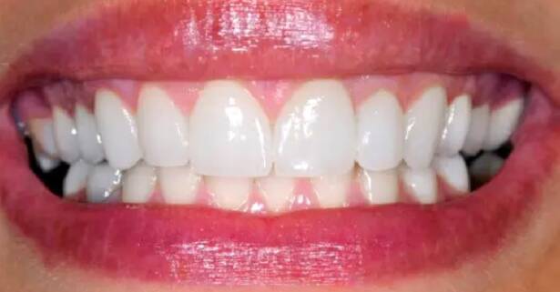 Blanqueamiento dental con led en Clínica Dental Odontoss