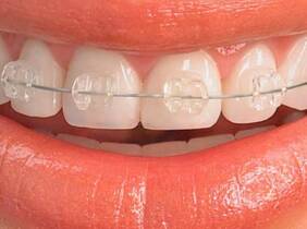 Ortodoncia de brackets metálicos o estéticos en Clínica Dental NGP