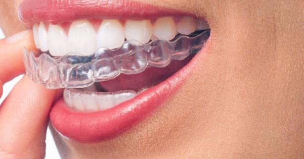 Descuento en Invisalign