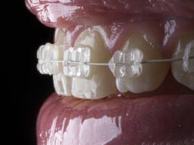 Tratamiento de ortodoncia a elegir en Clinica dental Orthoden