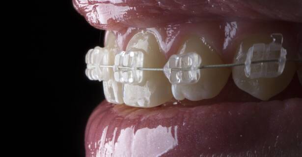 Tratamiento de ortodoncia a elegir en Clinica dental Orthoden