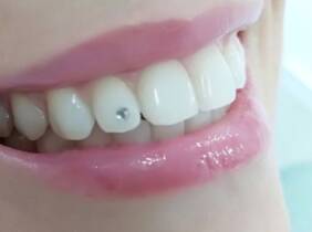 Limpieza dental con ultrasonidos en la clínica Ara Dental