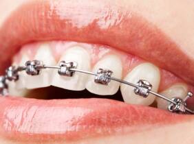 Ortodoncia con brackets a elegir en Clínica Futuredent