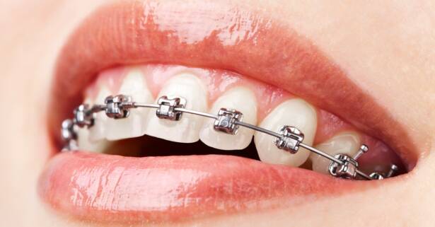 Ortodoncia con brackets a elegir en Clínica Futuredent